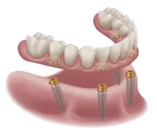 Illustration of a full arch of teeth seated on four dental implants