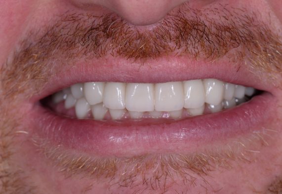 After dental treatment