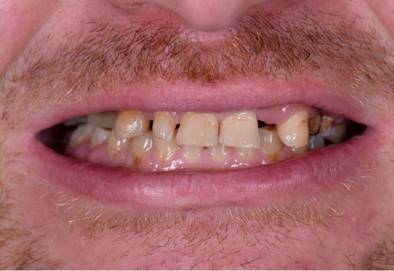 Before dental treatment