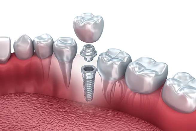 Single dental implant illustration