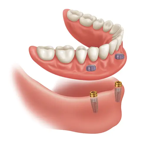 Illustration of a lower denture lifted above two dental implants